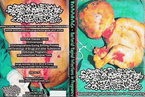 Wrong Illegal Abortion Procedure With Alarming Consequences : Bacterial Vaginal Infections In Pregnancy